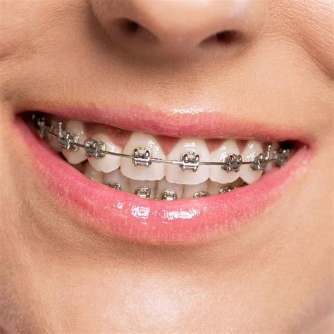 doe all metal braces brackets need wire|best wire for braces.